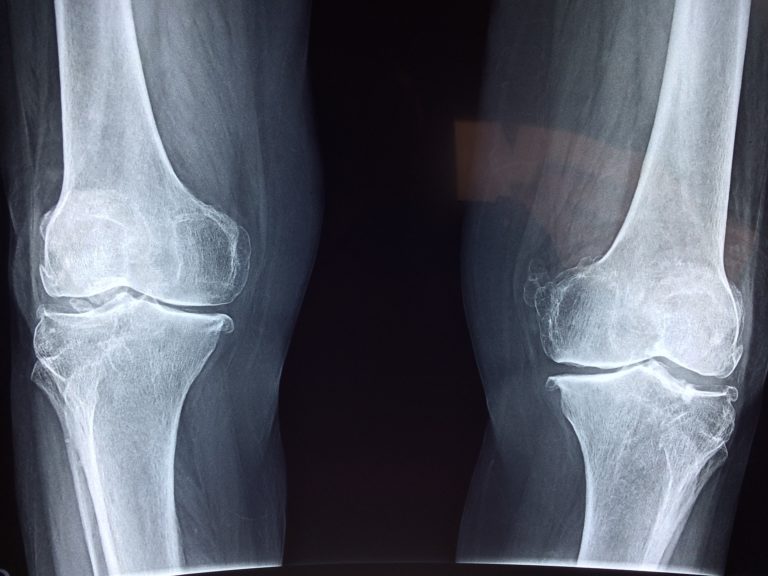 Artroskopia kolana – najlepsza diagnoza.